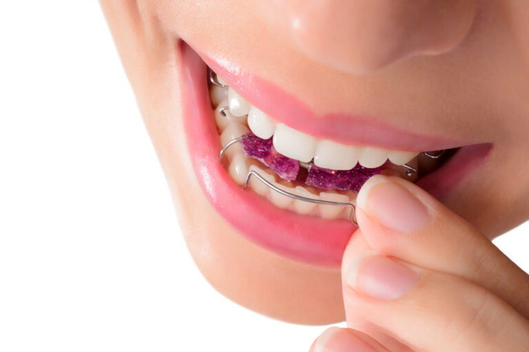 Woman wearing orthodontic removable brac