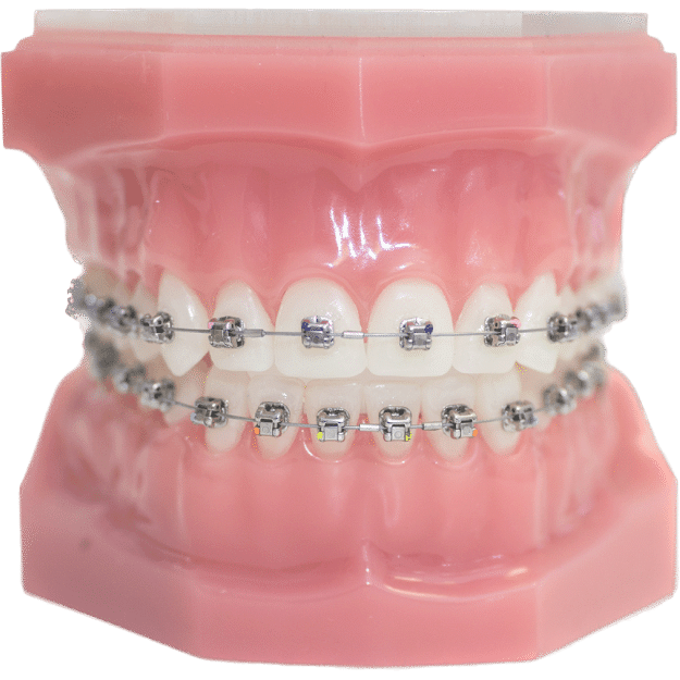 What Are Braces and How Do They Work