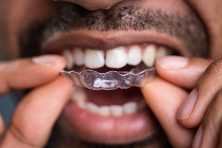 braces alternatives